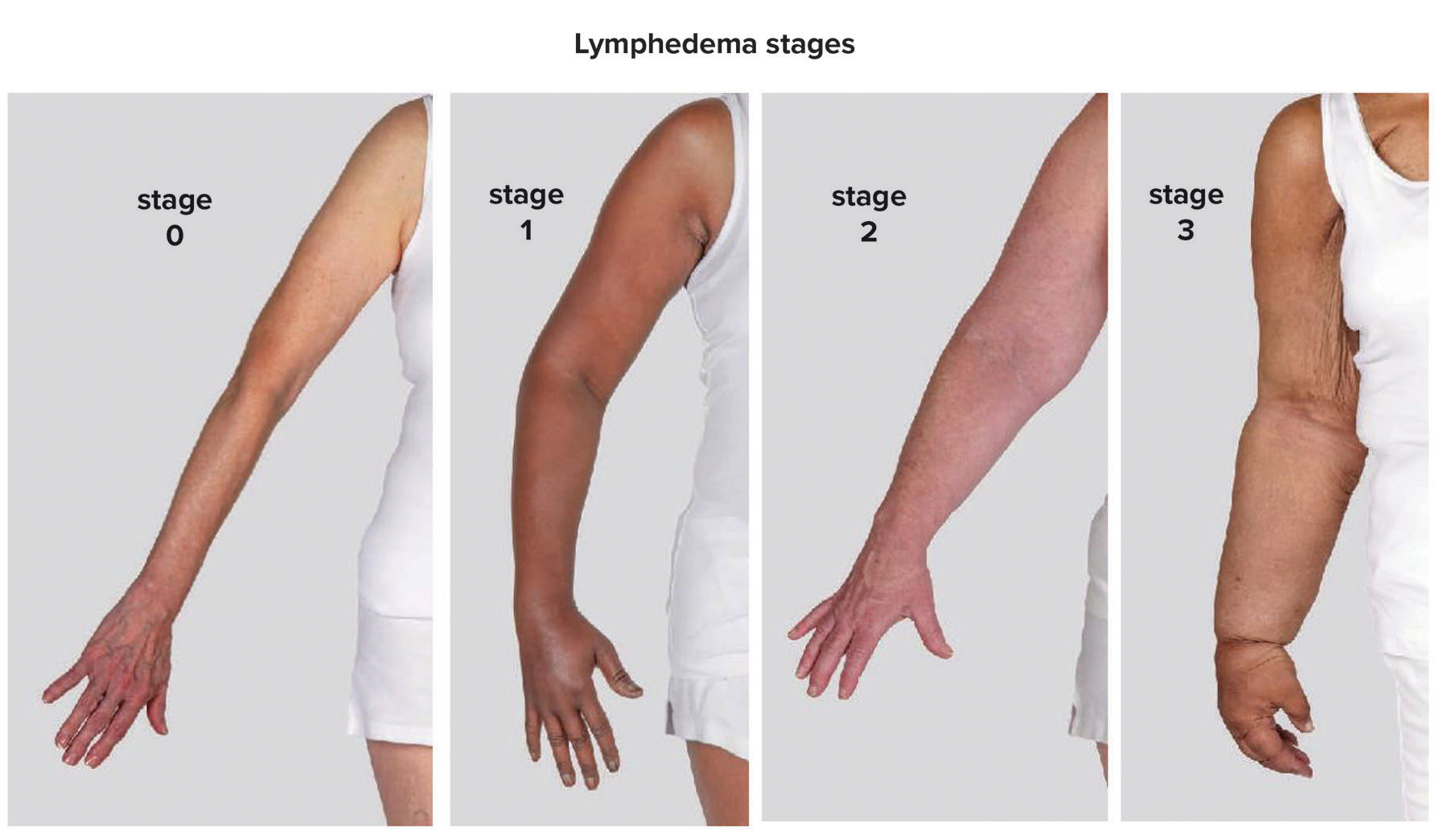 Lymphedema Managing Breast Cancer s Calling Card Blessing Health System lymphedema-managing-breast-cancer-s-calling-card-blessing-health-system